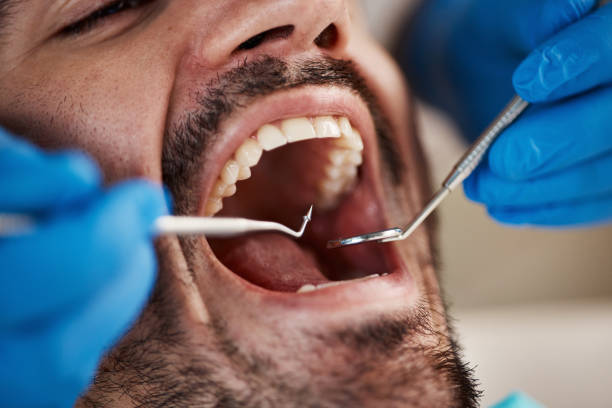 Best Emergency Dentist for Lost Fillings or Crowns in Cedarville, OH